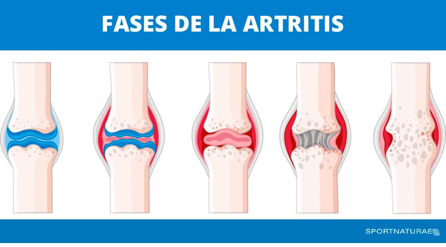Imagen de las distintas fases de la artritis en los huesos.